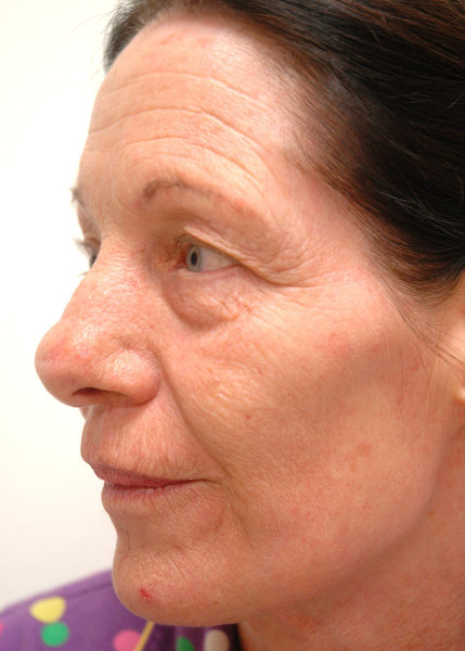 Wrinkle reduction