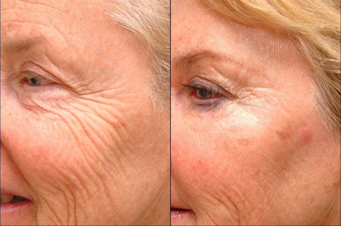 Wrinkle Reduction